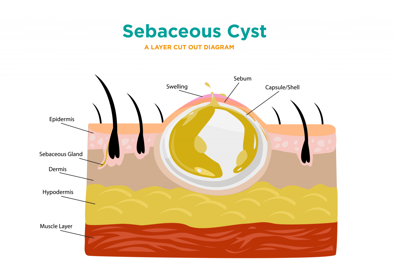 sebaceous-cyst-drsricharan